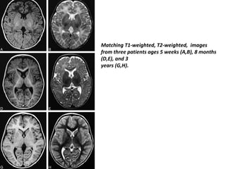 Matching T1-weighted, T2-weighted, images
from three patients ages 5 weeks (A,B), 8 months
(D,E), and 3
years (G,H).
 