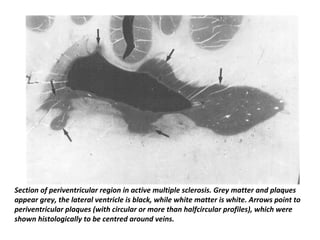 Section of periventricular region in active multiple sclerosis. Grey matter and plaques
appear grey, the lateral ventricle is black, while white matter is white. Arrows point to
periventricular plaques (with circular or more than halfcircular profiles), which were
shown histologically to be centred around veins.
 