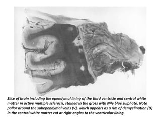 Slice of brain including the ependymal lining of the third ventricle and central white
matter in active multiple sclerosis, stained in the gross with Nile blue sulphate. Note
pallor around the subependymal veins (V), which appears as a rim of demyelination (D)
in the central white matter cut at right angles to the ventricular lining.
 