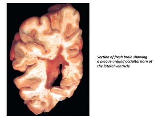 Section of fresh brain showing
a plaque around occipital horn of
the lateral ventricle
 
