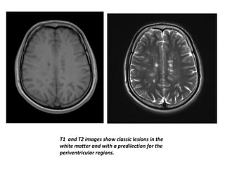 T1 and T2 images show classic lesions in the
white matter and with a predilection for the
periventricular regions.
 
