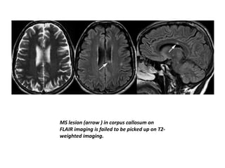 MS lesion (arrow ) in corpus callosum on
FLAIR imaging is failed to be picked up on T2-
weighted imaging.
 
