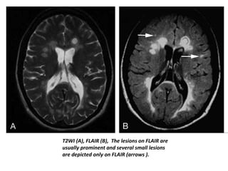 T2WI (A), FLAIR (B), The lesions on FLAIR are
usually prominent and several small lesions
are depicted only on FLAIR (arrows ).
 