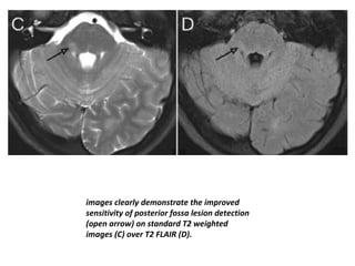images clearly demonstrate the improved
sensitivity of posterior fossa lesion detection
(open arrow) on standard T2 weighted
images (C) over T2 FLAIR (D).
 