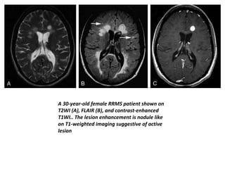 A 30-year-old female RRMS patient shown on
T2WI (A), FLAIR (B), and contrast-enhanced
T1WI.. The lesion enhancement is nodule like
on T1-weighted imaging suggestive of active
lesion
 