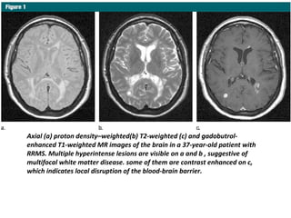 Axial (a) proton density–weighted(b) T2-weighted (c) and gadobutrol-
enhanced T1-weighted MR images of the brain in a 37-year-old patient with
RRMS. Multiple hyperintense lesions are visible on a and b , suggestive of
multifocal white matter disease. some of them are contrast enhanced on c,
which indicates local disruption of the blood-brain barrier.
 