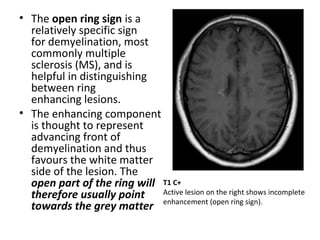 • The open ring sign is a
relatively specific sign
for demyelination, most
commonly multiple
sclerosis (MS), and is
helpful in distinguishing
between ring
enhancing lesions.
• The enhancing component
is thought to represent
advancing front of
demyelination and thus
favours the white matter
side of the lesion. The
open part of the ring will
therefore usually point
towards the grey matter
T1 C+
Active lesion on the right shows incomplete
enhancement (open ring sign).
 