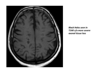 Black Holes seen in
T1WI s/o more severe
axonal tissue loss
 
