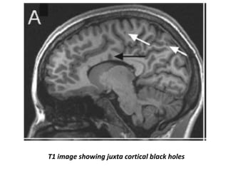 T1 image showing juxta cortical black holes
 