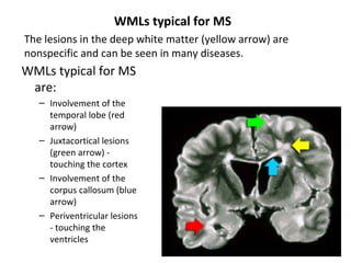 WMLs typical for MS
are:
– Involvement of the
temporal lobe (red
arrow)
– Juxtacortical lesions
(green arrow) -
touching the cortex
– Involvement of the
corpus callosum (blue
arrow)
– Periventricular lesions
- touching the
ventricles
The lesions in the deep white matter (yellow arrow) are
nonspecific and can be seen in many diseases.
WMLs typical for MS
 