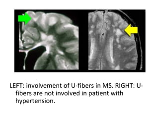 LEFT: involvement of U-fibers in MS. RIGHT: U-
fibers are not involved in patient with
hypertension.
 