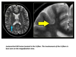 Juxtacortical MS lesion located in the U-fiber. The involvement of the U-fibers is
best seen on the magnification view.
 