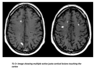 T1 C+ image showing multiple active juxta cortical lesions touching the
cortex
 