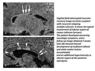 Sagittal fluid-attenuated inversion
recovery image are from a patient
with recurrent relapsing
multiple sclerosis. A shows the typical
involvement of inferior aspect of
corpus callosum (arrows).
The patient developed worsening
neurologic symptoms, and a
follow-up image obtained 7 weeks
later (B) showed interval
development of confluent callosal
and white matter lesions
(arrowheads)
and an additional hyperintensity in
inferior aspect of the posterior
ependyma.
 