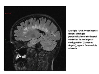Multiple FLAIR hyperintense
lesions arranged
perpendicular to the lateral
ventricles in a triangular
configuration (Dawson's
fingers), typical for multiple
sclerosis.
 