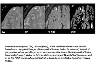 Intermediate-weighted [IW] , T2-weighted) , FLAIR and three-dimensional double-
inversion-recovery(DIR) images of intracortical lesions. Lesion (arrowhead) in cortical
gray matter, with a possible juxtacortical component is shown. The intracortical lesion
is particularly poorly visible on intermediate-weighted and T2-weighted images, as well
as on the FLAIR image, whereas it is depicted clearly on the double-inversion-recovery
image..
 