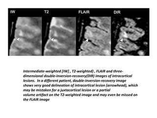 Intermediate-weighted [IW] , T2-weighted) , FLAIR and three-
dimensional double-inversion-recovery(DIR) images of intracortical
lesions. In a different patient, double-inversion-recovery image
shows very good delineation of intracortical lesion (arrowhead), which
may be mistaken for a juxtacortical lesion or a partial
volume artifact on the T2-weighted image and may even be missed on
the FLAIR image
 