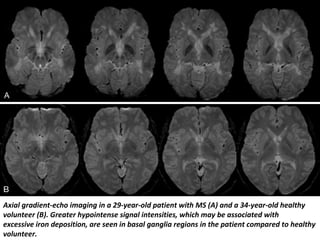 Axial gradient-echo imaging in a 29-year-old patient with MS (A) and a 34-year-old healthy
volunteer (B). Greater hypointense signal intensities, which may be associated with
excessive iron deposition, are seen in basal ganglia regions in the patient compared to healthy
volunteer.
 