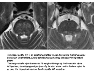 The image on the left is an axial T2 weighted image illustrating typical vascular
brainstem involvement, with a central involvement of the transverse pontine
fibers.
The image on the right is an axial T2 weighted image of the brainstem of an
MS-patient, showing typical peripherally located white matter lesions, often in
or near the trigeminal tract, or bordering the 4th ventricle.
 