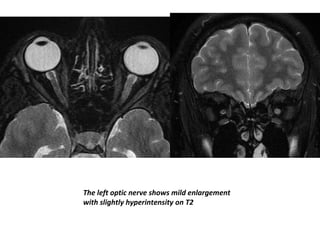 The left optic nerve shows mild enlargement
with slightly hyperintensity on T2
 