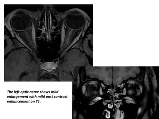 The left optic nerve shows mild
enlargement with mild post contrast
enhancement on T1.
 