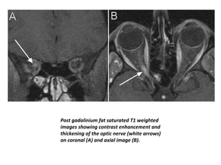 Post gadolinium fat saturated T1 weighted
images showing contrast enhancement and
thickening of the optic nerve (white arrows)
on coronal (A) and axial image (B).
 