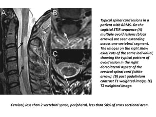 Typical spinal cord lesions in a
patient with RRMS. On the
sagittal STIR sequence (A)
multiple ovoid lesions (black
arrows) are seen extending
across one vertebral segment.
The images on the right show
axial cuts of the same individual,
showing the typical pattern of
ovoid lesion in the right
dorsolateral aspect of the
cervical spinal cord (white
arrow). (B) post gadolinium
contrast T1 weighted image, (C)
T2 weighted image.
Cervical, less than 2 vertebral space, peripheral, less than 50% of cross sectional area.
 