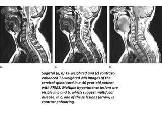 4
Sagittal (a, b) T2-weighted and (c) contrast-
enhanced T1-weighted MR images of the
cervical spinal cord in a 46 year-old patient
with RRMS. Multiple hyperintense lesions are
visible in a and b, which suggest multifocal
disease. In c, one of these lesions (arrow) is
contrast enhancing.
 
