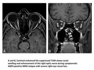 A and B, Contrast-enhanced fat-suppressed T1WI shows acute
swelling and enhancement of the right optic nerve during symptomatic
AQP4-positive NMO relapse with severe right-eye visual loss.
 