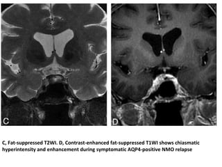 C, Fat-suppressed T2WI. D, Contrast-enhanced fat-suppressed T1WI shows chiasmatic
hyperintensity and enhancement during symptomatic AQP4-positive NMO relapse
 