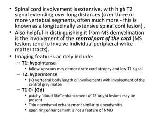 • Spinal cord involvement is extensive, with high T2
signal extending over long distances (over three or
more vertebral segments, often much more - this is
known as a longitudinally extensive spinal cord lesion) .
• Also helpful in distinguishing it from MS demyelination
is the involvement of the central part of the cord (MS
lesions tend to involve individual peripheral white
matter tracts).
• Imaging features acutely include:
– T1: hypointense
• follow-up scans may demonstrate cord atrophy and low T1 signal
– T2: hyperintense
• (>3 vertebral body length of involvement) with involvement of the
central grey matter
– T1 C+ (Gd)
• patchy "cloud like" enhancement of T2 bright lesions may be
present
• Thin ependymal enhancement similar to ependymitis
• open ring enhancement is not a feature of NMO
 