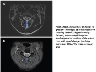 Axial T2 fast spin echo (A) and axial T2
gradient (B) images of the cervical cord
showing central T2 hyperintensity
(arrows) in neuromyelitis optica
involving central portions of the spinal
cord with signal changes involving
more than 50% of the cross-sectional
area
 