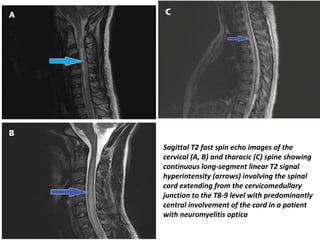 Sagittal T2 fast spin echo images of the
cervical (A, B) and thoracic (C) spine showing
continuous long-segment linear T2 signal
hyperintensity (arrows) involving the spinal
cord extending from the cervicomedullary
junction to the T8-9 level with predominantly
central involvement of the cord in a patient
with neuromyelitis optica
 