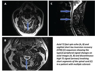 Axial T2 fast spin echo (A, B) and
sagittal short tau inversion recovery
(STIR) (C) sequences showing the
typical peripheral signal changes on
axial images (A, B) and discontinuous
high T2 signal (arrows) involving
short segments of the spinal cord (C)
in a patient with multiple sclerosis
 