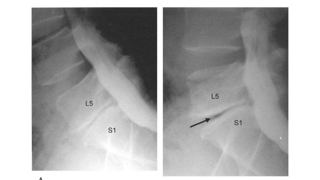 Imaging of lumbar spondylosis