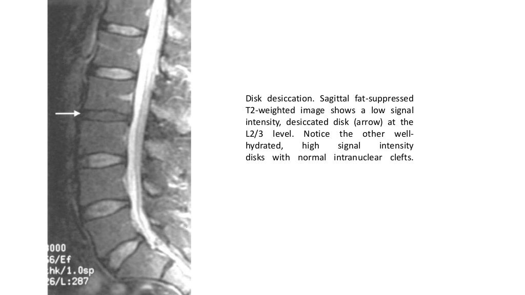 Imaging of lumbar spondylosis