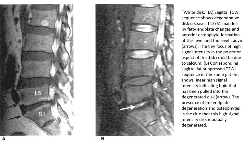 Imaging of lumbar spondylosis