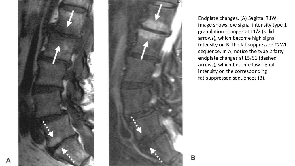 Imaging of lumbar spondylosis