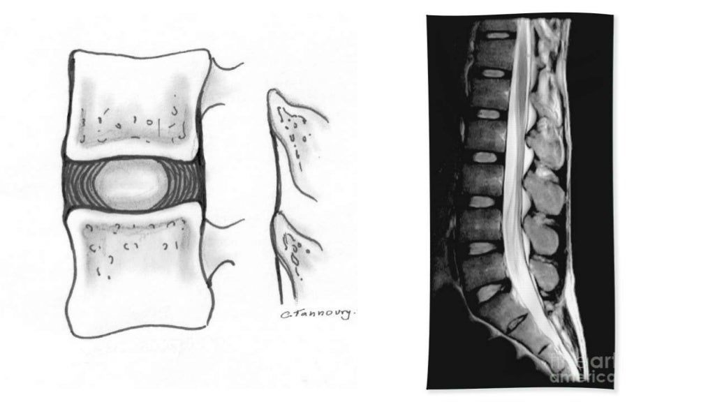 Imaging of lumbar spondylosis