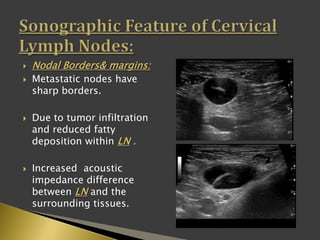  Nodal Borders& margins:
 Metastatic nodes have
sharp borders.
 Due to tumor infiltration
and reduced fatty
deposition within LN .
 Increased acoustic
impedance difference
between LN and the
surrounding tissues.
 