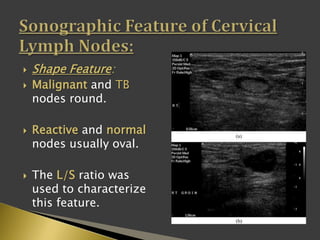  Shape Feature:
 Malignant and TB
nodes round.
 Reactive and normal
nodes usually oval.
 The L/S ratio was
used to characterize
this feature.
 