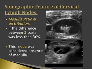  Medulla Ratio &
distribution:
 If the difference
between 2 parts
was less than 30%.
 This node was
considered absence
of medulla.
 