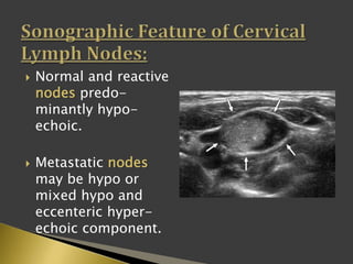  Normal and reactive
nodes predo-
minantly hypo-
echoic.
 Metastatic nodes
may be hypo or
mixed hypo and
eccenteric hyper-
echoic component.
 