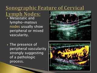  Metastatic and
lympho-matous
nodes usually show
peripheral or mixed
vascularity.
 The presence of
peripheral vascularity
strongly suggesting
of a pathologic
process.
 