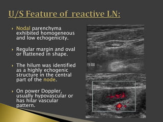  Nodal parenchyma
exhibited homogeneous
and low echogenicity.
 Regular margin and oval
or flattened in shape.
 The hilum was identified
as a highly echogenic
structure in the central
part of the node.
 On power Doppler,
usually hypovascular or
has hilar vascular
pattern.
 