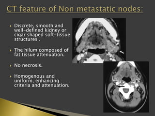  Discrete, smooth and
well-defined kidney or
cigar shaped soft-tissue
structures .
 The hilum composed of
fat tissue attenuation.
 No necrosis.
 Homogenous and
uniform, enhancing
criteria and attenuation.
 