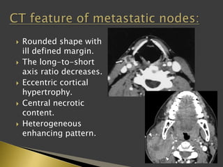  Rounded shape with
ill defined margin.
 The long-to-short
axis ratio decreases.
 Eccentric cortical
hypertrophy.
 Central necrotic
content.
 Heterogeneous
enhancing pattern.
 