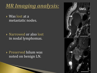  Was lost at a
metastatic nodes.
 Narrowed or also lost
in nodal lymphomas.
 Preserved hilum was
noted on benign LN.
 
