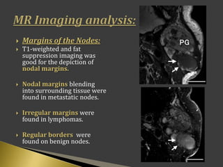  Margins of the Nodes:
 T1-weighted and fat
suppression imaging was
good for the depiction of
nodal margins.
 Nodal margins blending
into surrounding tissue were
found in metastatic nodes.
 Irregular margins were
found in lymphomas.
 Regular borders were
found on benign nodes.
 