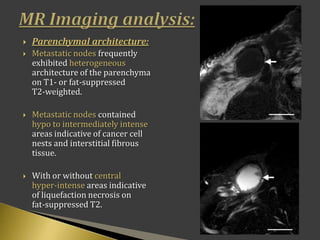 Parenchymal architecture:
 Metastatic nodes frequently
exhibited heterogeneous
architecture of the parenchyma
on T1- or fat-suppressed
T2-weighted.
 Metastatic nodes contained
hypo to intermediately intense
areas indicative of cancer cell
nests and interstitial fibrous
tissue.
 With or without central
hyper-intense areas indicative
of liquefaction necrosis on
fat-suppressed T2.
 